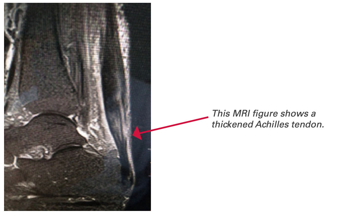MRI showing a thickened Achilles tendon