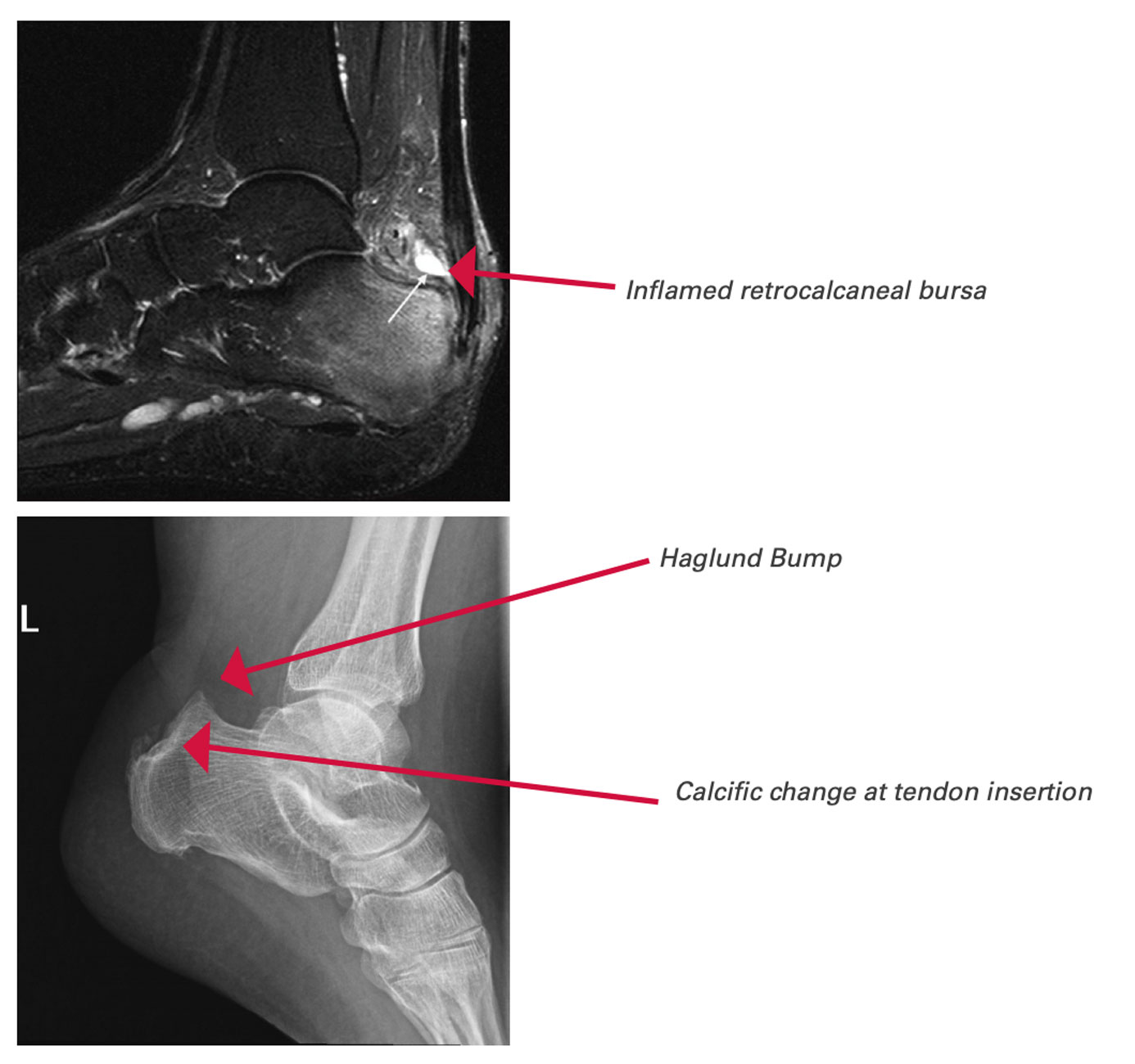 Achilles tendinopathy example