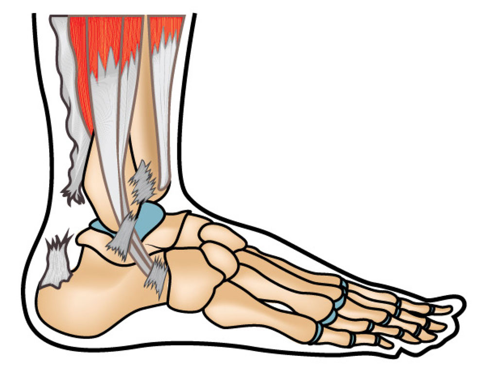 Diagram showing an Achilles tendon rupture