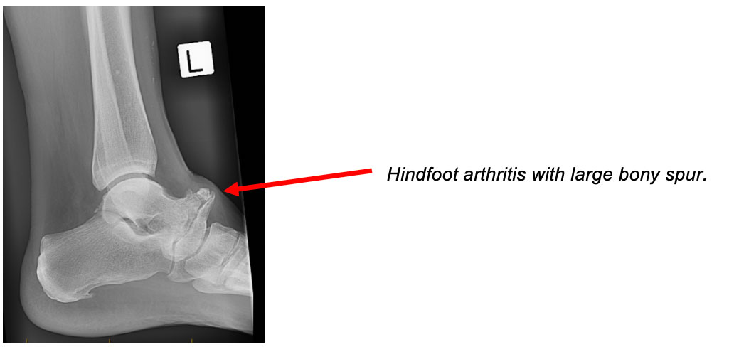 Standing X-rays are used in the assessment of ankle and hindfoot arthritis.
