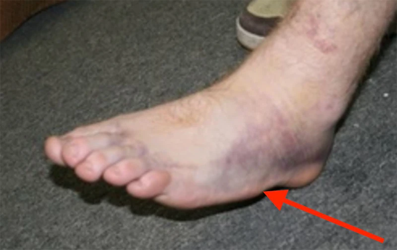 The base of the 5th metatarsal is the small prominence on the outer border of your midfoot.