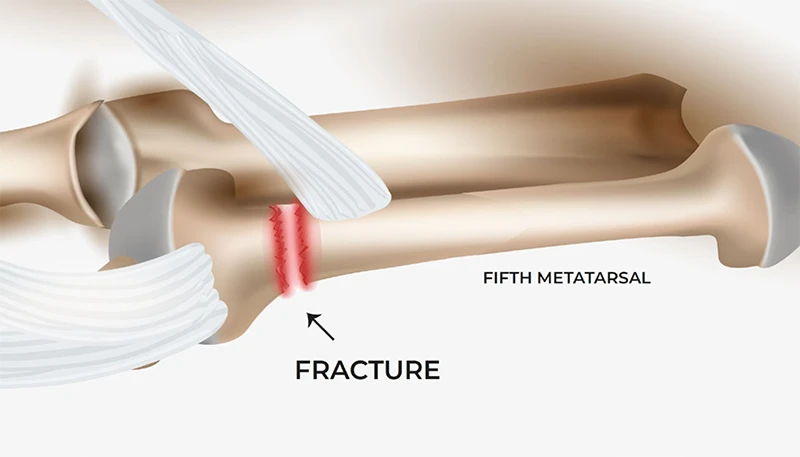 There is an important tendon called “Peroneus Brevis” that attaches at the site and pulls off or “avulses” the bone from the rest of the metatarsal as it attempts to stop you falling over.