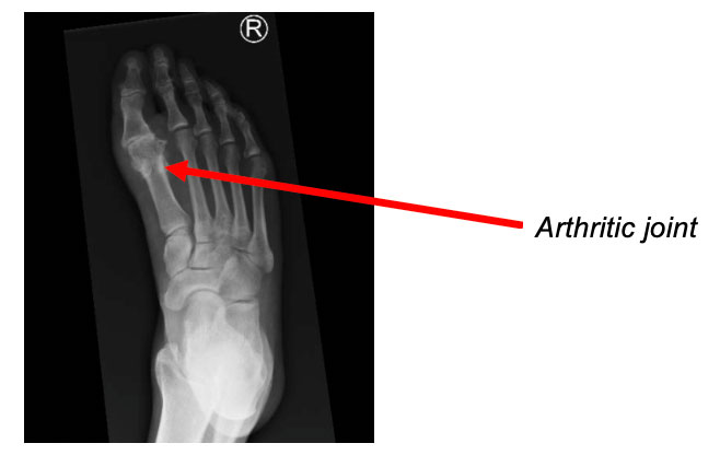 Big toe arthritis x-ray