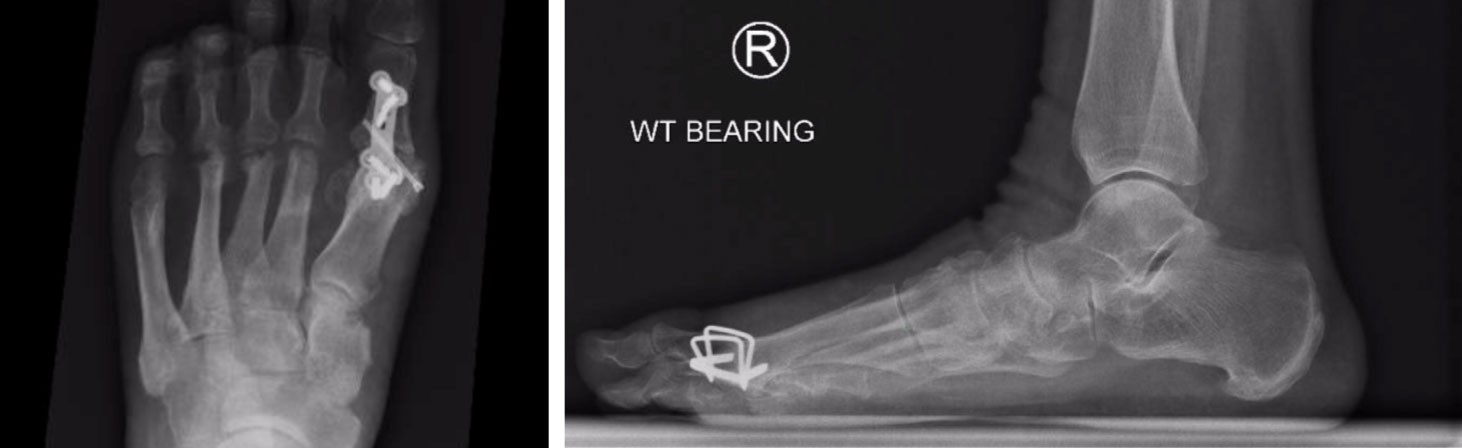 There are three types of surgery used in hallux rigidus.