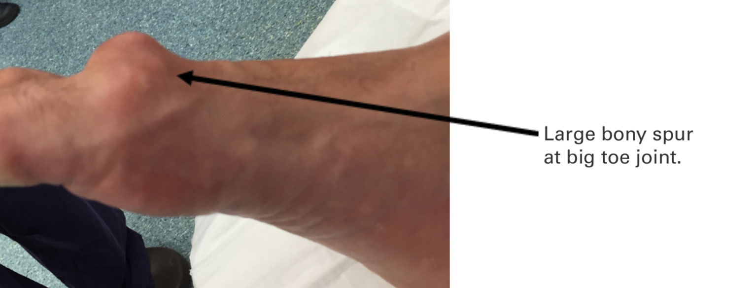 Big Toe Arthritis & Joint Pain Treatment Melbourne Big Toe Fusion