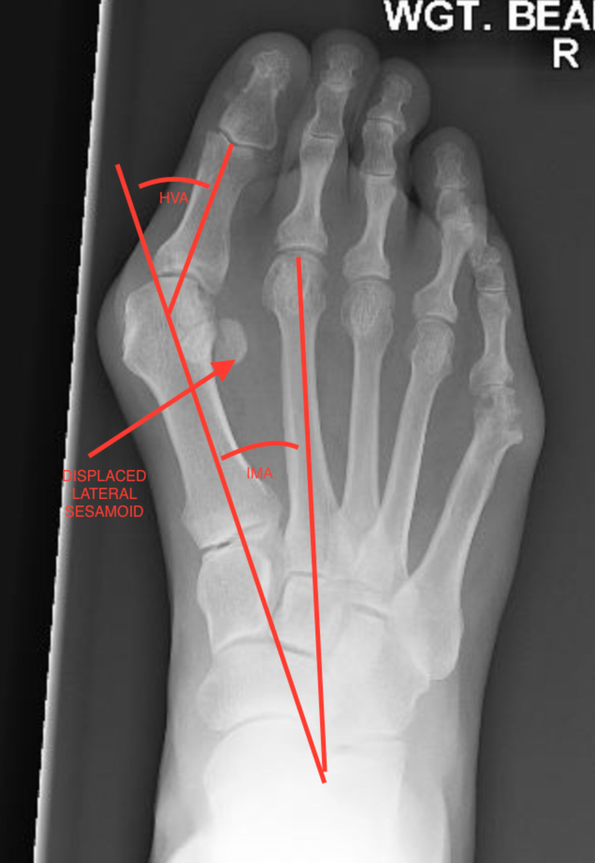 Weight bearing x-rays are used to accurately assess deformity in bunions.