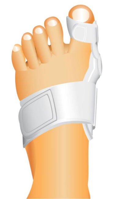Bunion splints can hold the toe in a corrected position