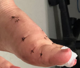 Keyhole bunion surgery example