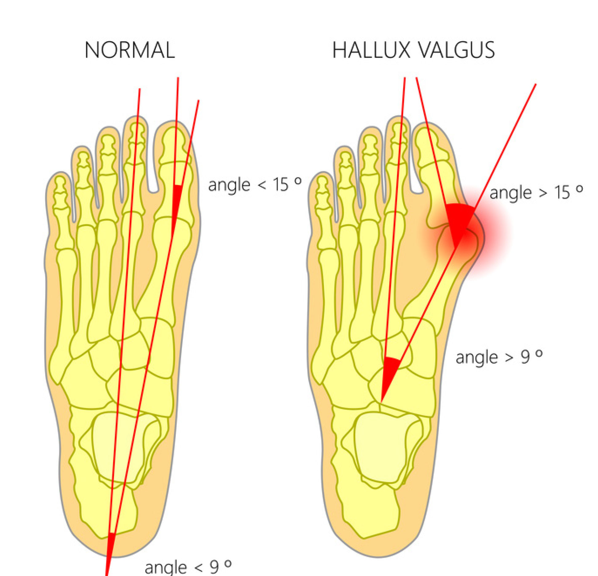Diagram showing normal foot vs foot with hallux valgus