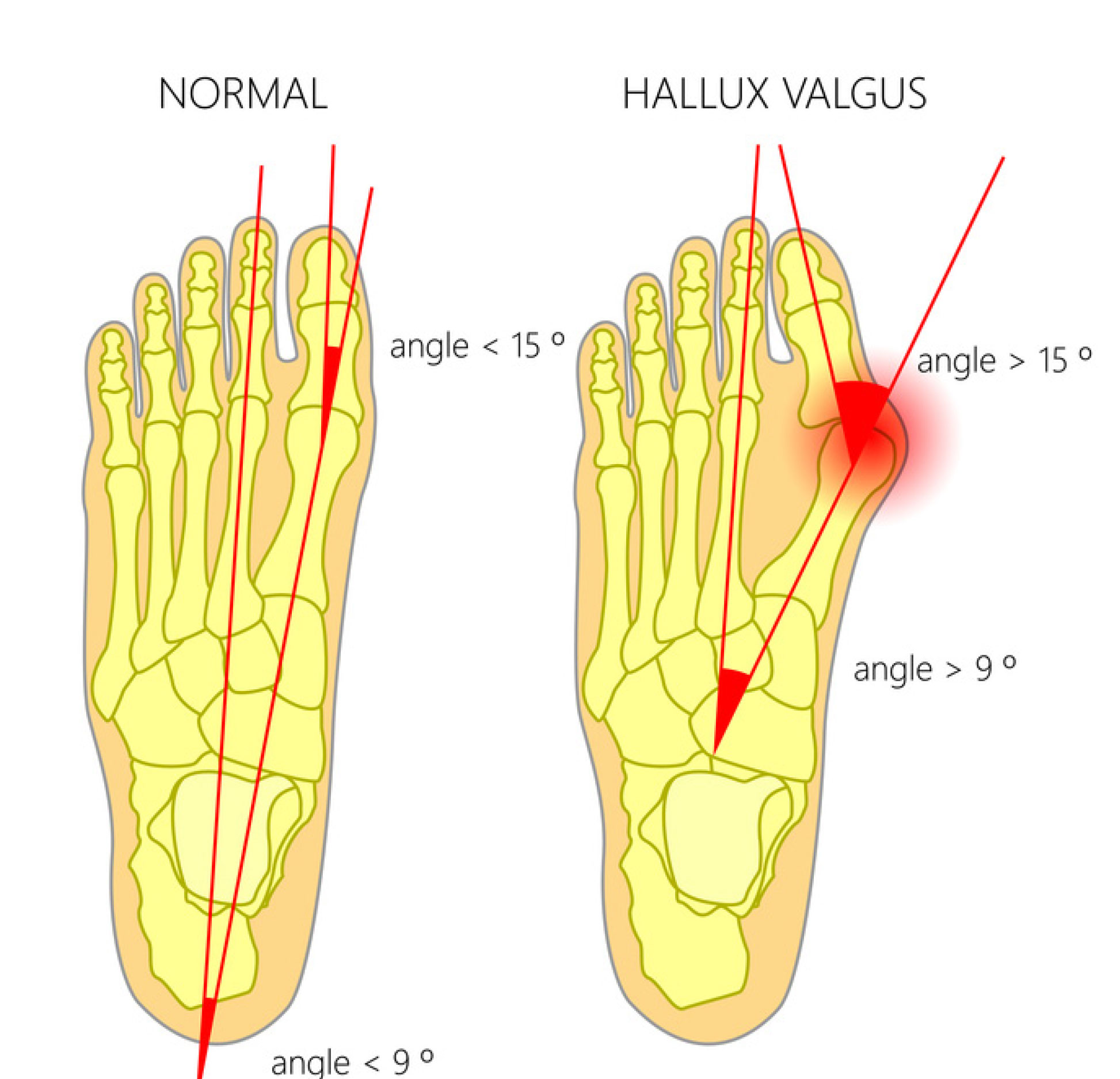 Hallux valgus что это