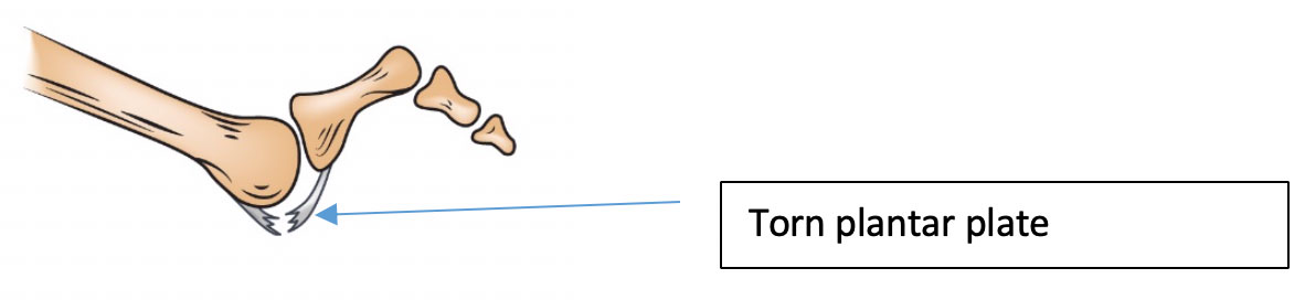 Hammer toe from plantar plate tear