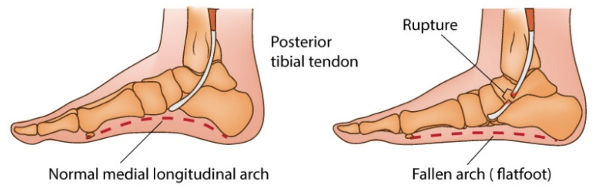 Diagram of normal foot vs posterior tibial tendon rupture