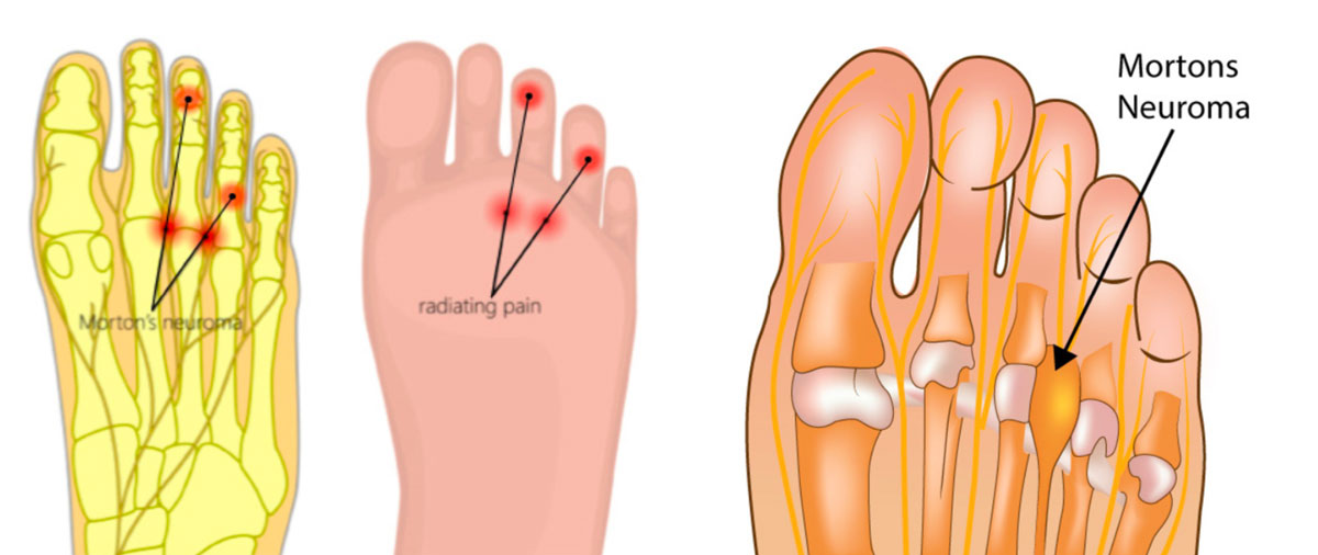 Weight bearing x-rays are used to accurately assess deformity in bunions.