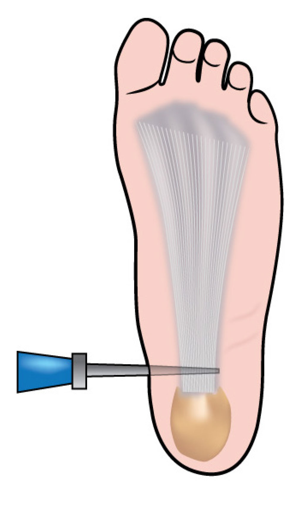 Diagram showing a plantar fasciitis release