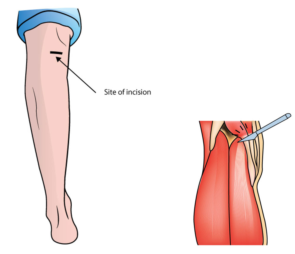 Diagram showing a proximan medial gastrocnemius release