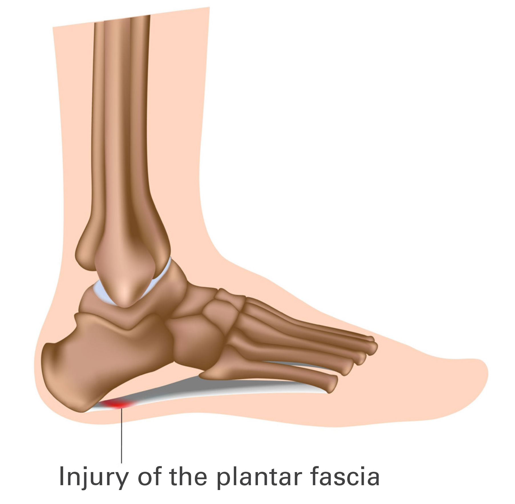 Diagram showing injury of the plantar fascia