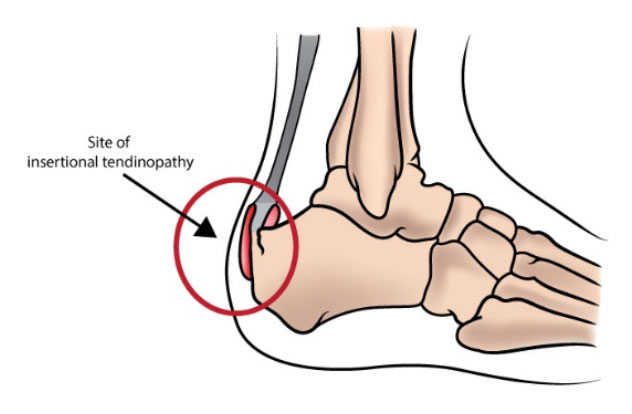 Site of insertional tendinopathy