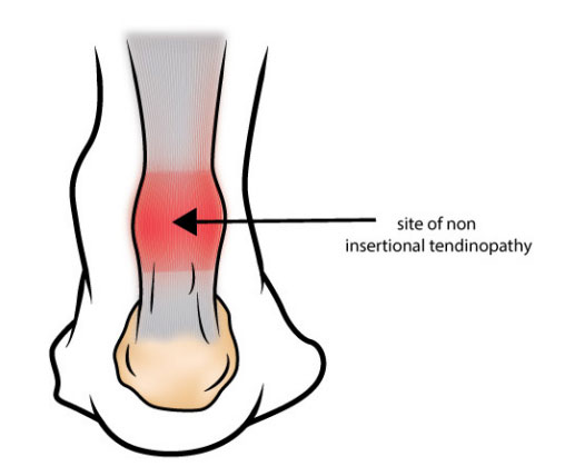 Site of insertional tendinopathy