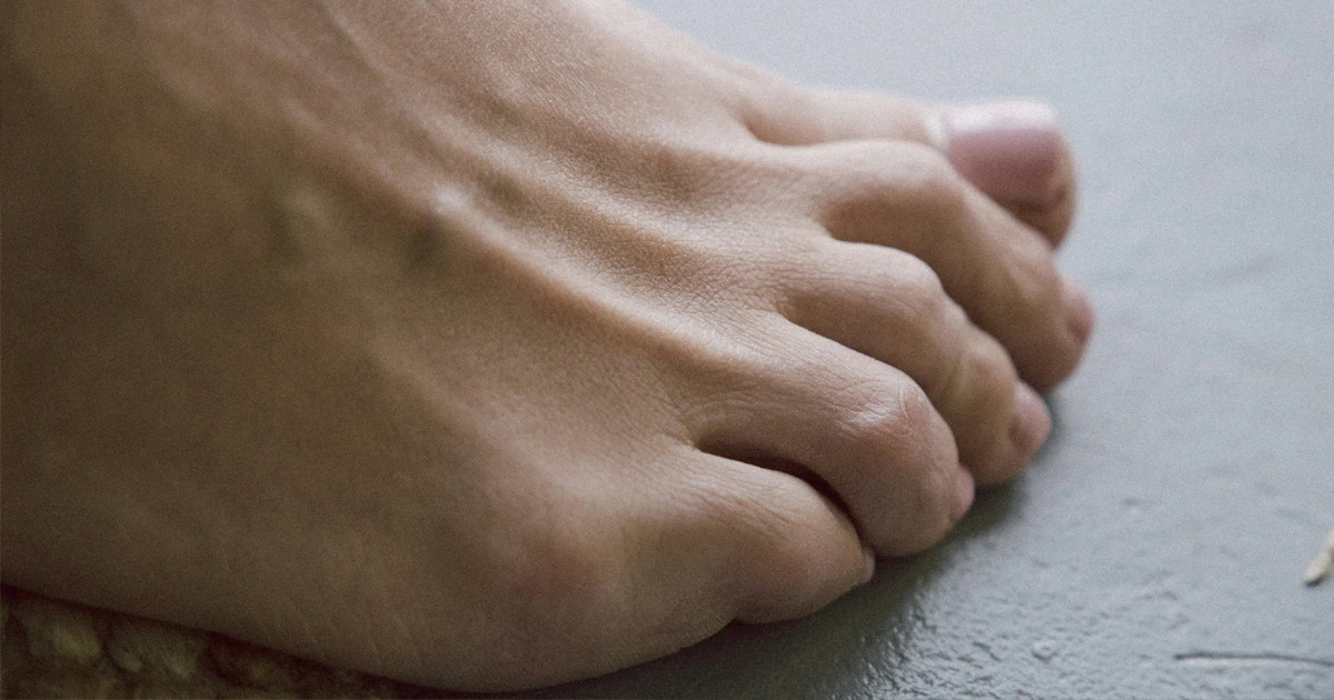 Not every hammertoe needs surgery right away. Here's how timing actually gets decided, and what's worth trying first. 